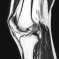 MRI – Left Knee – Slice 14 – Jan 2011