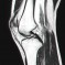 MRI - Left Knee - Slice 15 - Jan 2011